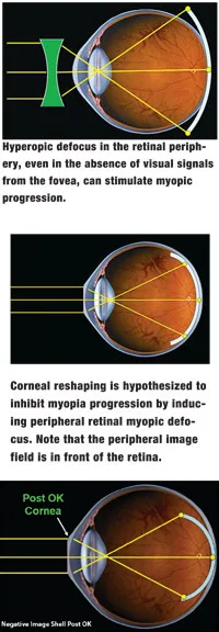 Diagrams of peripheral retinal defocus and how corneal reshaping moves the image in front of the retina