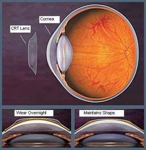 Diagram of a CRT lens reshaping the cornea overnight